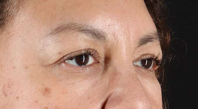 Blepharoplasty (Eyelid Surgery) Before & After Patient #4349