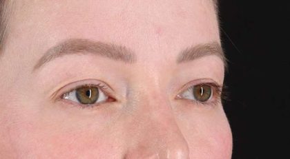 Blepharoplasty (Eyelid Surgery) Before & After Patient #4360