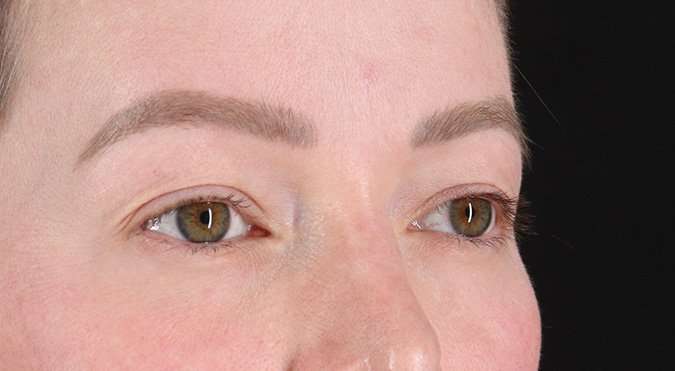 Blepharoplasty (Eyelid Surgery) Before & After Patient #4360
