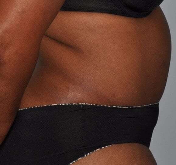 Abdominoplasty (Tummy Tuck) Before & After Patient #913