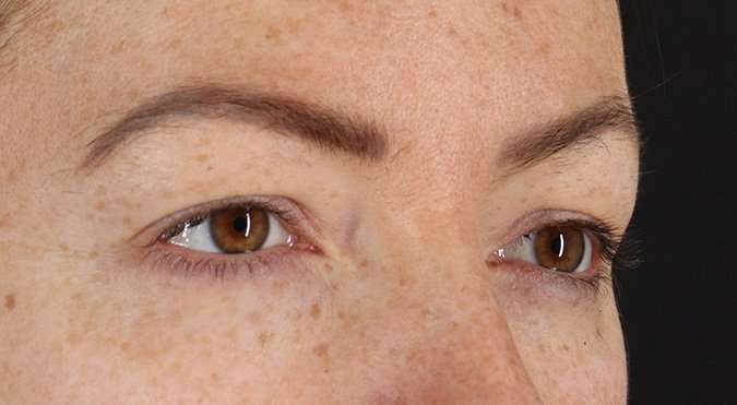 Blepharoplasty (Eyelid Surgery) Before & After Patient #4371