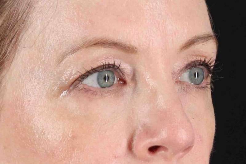 Blepharoplasty (Eyelid Surgery) Before & After Patient #4382