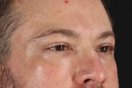 Blepharoplasty (Eyelid Surgery) Before & After Patient #4393