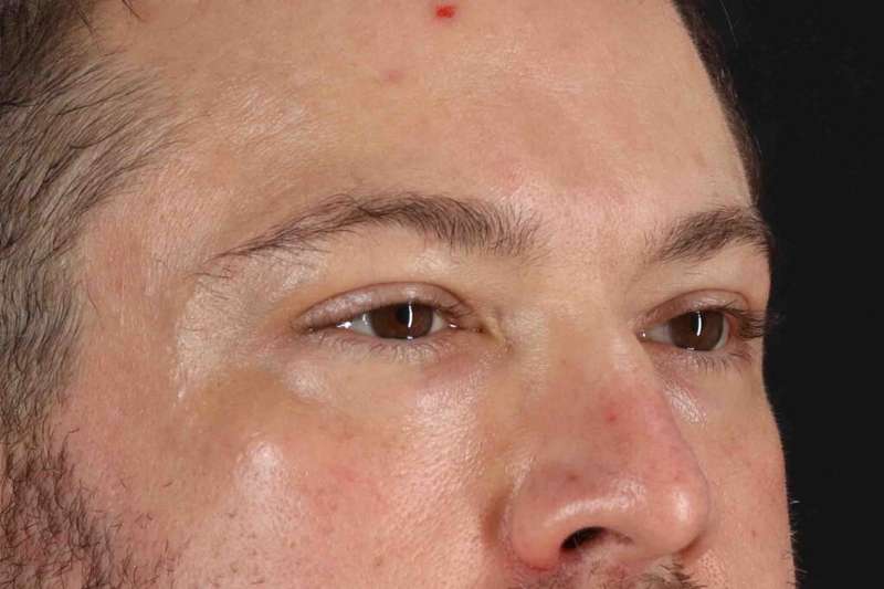 Blepharoplasty (Eyelid Surgery) Before & After Patient #4393