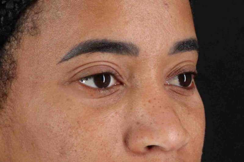 Blepharoplasty (Eyelid Surgery) Before & After Patient #4404
