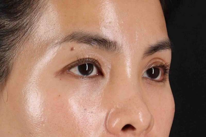 Blepharoplasty (Eyelid Surgery) Before & After Patient #4415