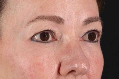 Blepharoplasty (Eyelid Surgery) Before & After Patient #4426