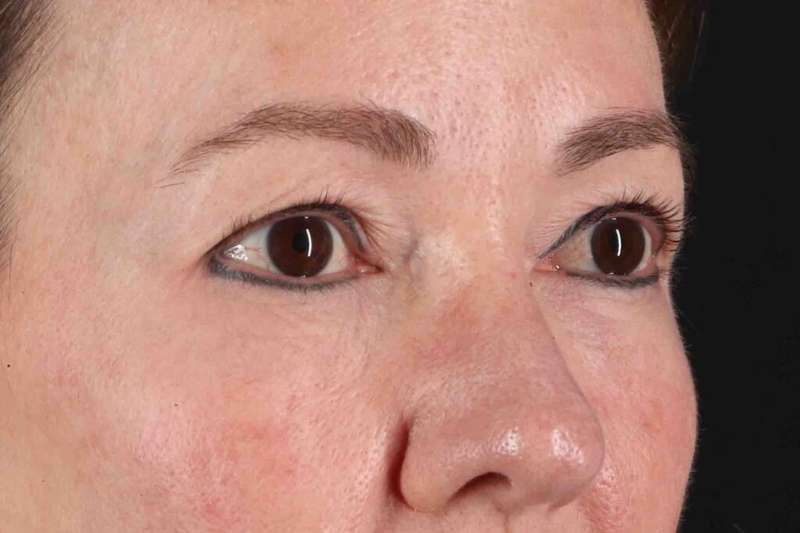 Blepharoplasty (Eyelid Surgery) Before & After Patient #4426