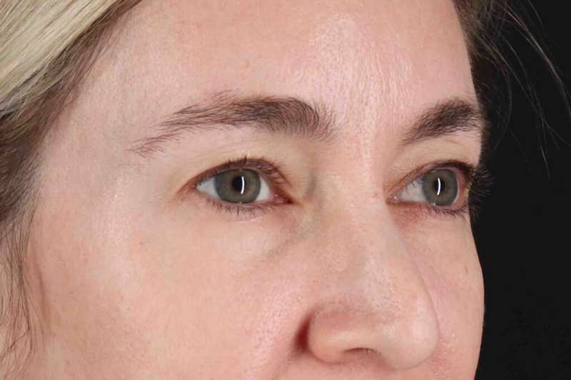 Blepharoplasty (Eyelid Surgery) Before & After Patient #4437
