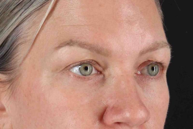 Blepharoplasty (Eyelid Surgery) Before & After Patient #4448