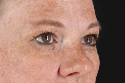 Blepharoplasty (Eyelid Surgery) Before & After Patient #4459