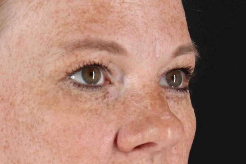 Blepharoplasty (Eyelid Surgery) Before & After Patient #4459