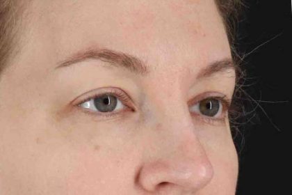Blepharoplasty (Eyelid Surgery) Before & After Patient #4470