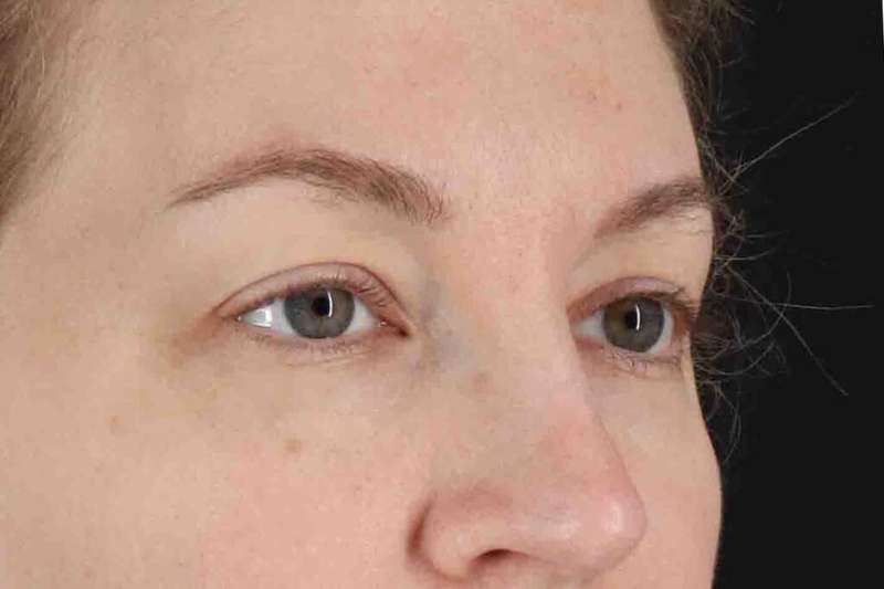 Blepharoplasty (Eyelid Surgery) Before & After Patient #4470