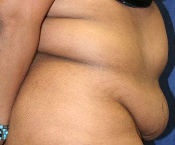 Abdominoplasty (Tummy Tuck) Before & After Patient #920