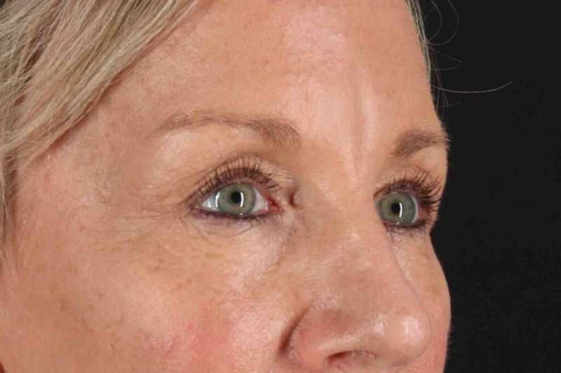 Blepharoplasty (Eyelid Surgery) Before & After Patient #4492