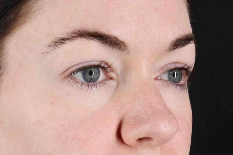 Blepharoplasty (Eyelid Surgery) Before & After Patient #4503