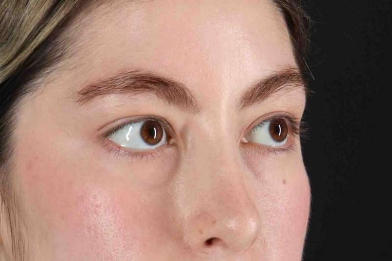 Blepharoplasty (Eyelid Surgery) Before & After Patient #4514