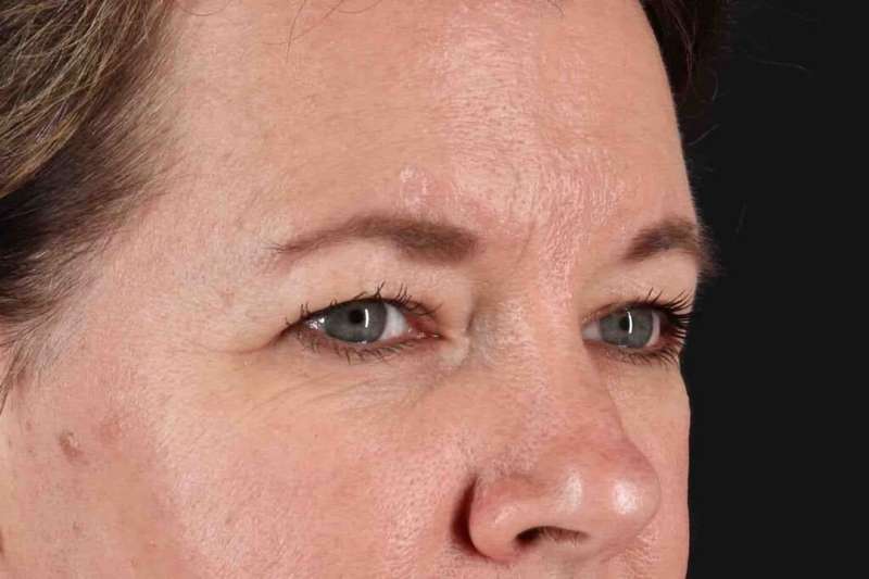 Blepharoplasty (Eyelid Surgery) Before & After Patient #4536