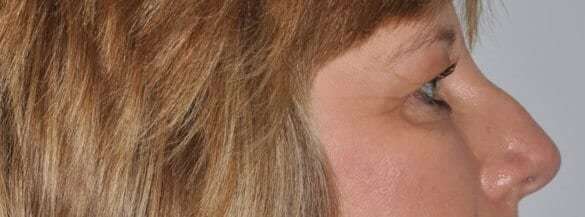 Blepharoplasty (Eyelid Surgery) Before & After Patient #4546