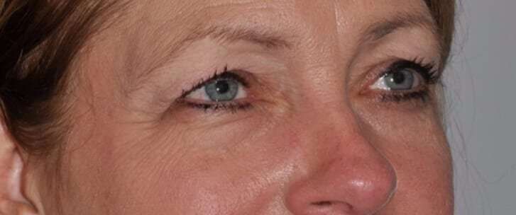 Blepharoplasty (Eyelid Surgery) Before & After Patient #4553