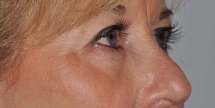 Blepharoplasty (Eyelid Surgery) Before & After Patient #4560