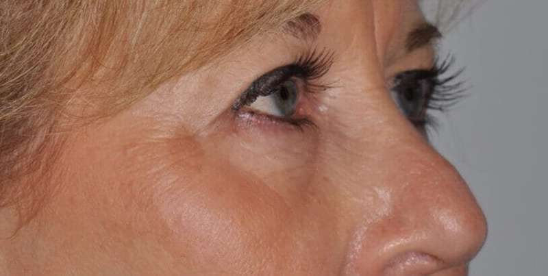 Blepharoplasty (Eyelid Surgery) Before & After Patient #4560
