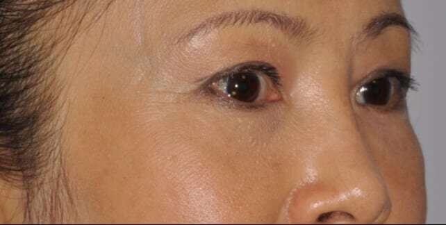Blepharoplasty (Eyelid Surgery) Before & After Patient #4567
