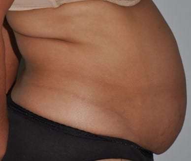 Abdominoplasty (Tummy Tuck) Before & After Patient #928