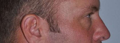 Blepharoplasty (Eyelid Surgery) Before & After Patient #4574