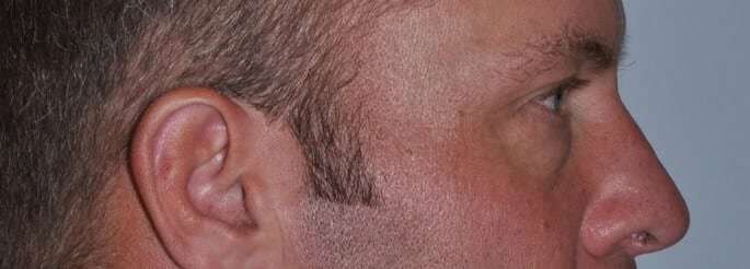 Blepharoplasty (Eyelid Surgery) Before & After Patient #4574
