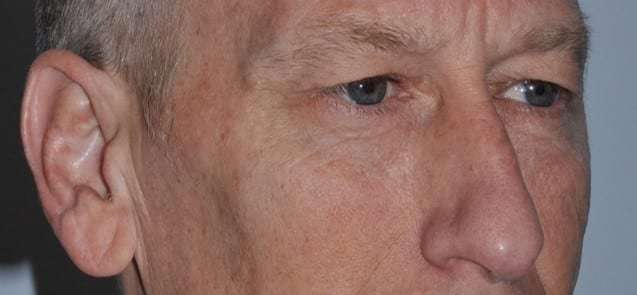 Blepharoplasty (Eyelid Surgery) Before & After Patient #4581