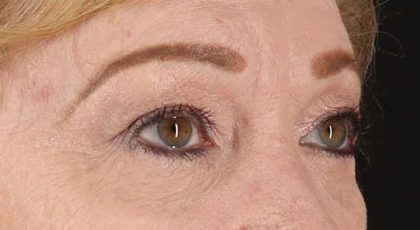 Blepharoplasty (Eyelid Surgery) Before & After Patient #4588