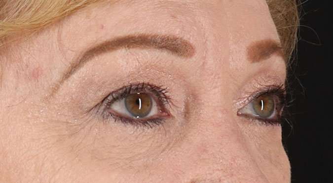 Blepharoplasty (Eyelid Surgery) Before & After Patient #4588