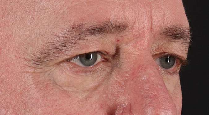 Blepharoplasty (Eyelid Surgery) Before & After Patient #4599