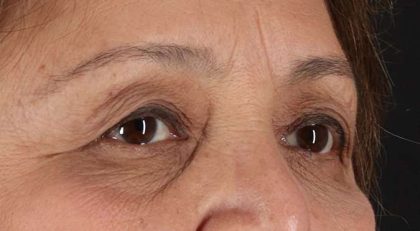 Blepharoplasty (Eyelid Surgery) Before & After Patient #4649