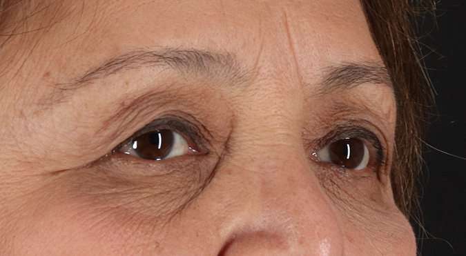 Blepharoplasty (Eyelid Surgery) Before & After Patient #4649
