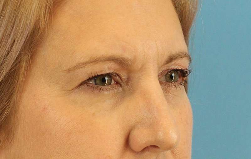 Brow Lift Before & After Patient #4672