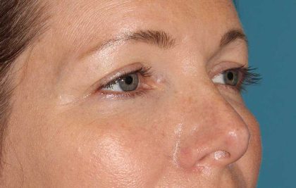 Brow Lift Before & After Patient #4679