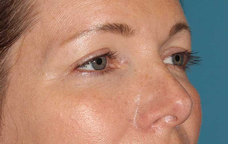 Brow Lift Before & After Patient #4679