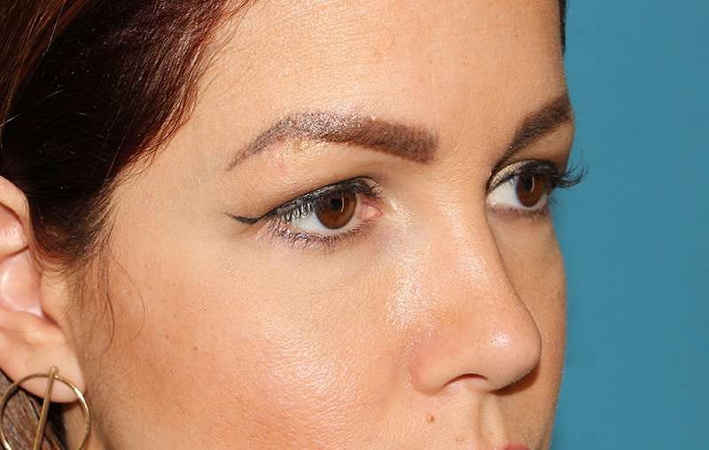 Brow Lift Before & After Patient #4690