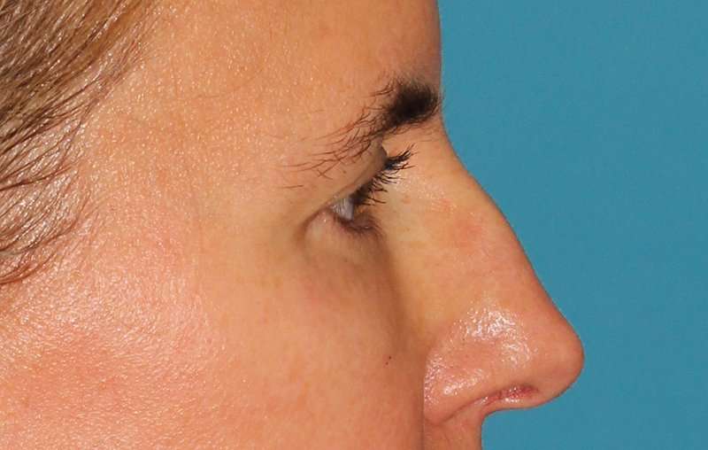 Brow Lift Before & After Patient #4697