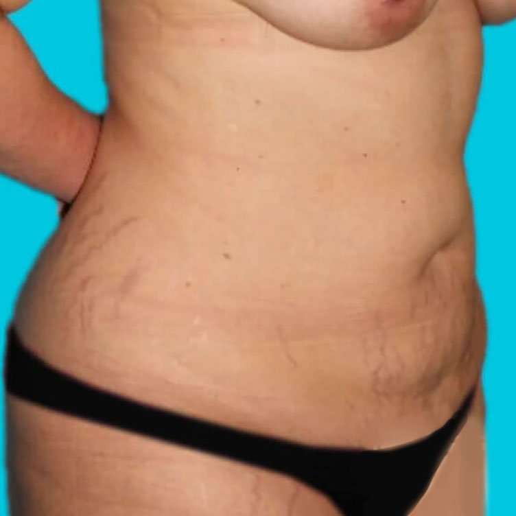 Abdominoplasty (Tummy Tuck) Before & After Patient #936