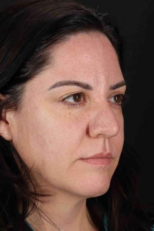 Brow Lift Before & After Patient #4733