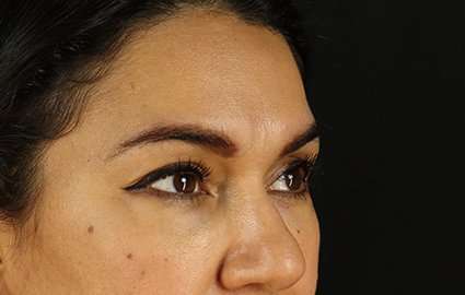 Brow Lift Before & After Patient #4744