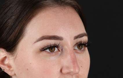 Brow Lift Before & After Patient #4766