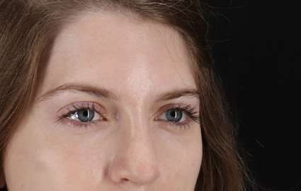 Brow Lift Before & After Patient #4777