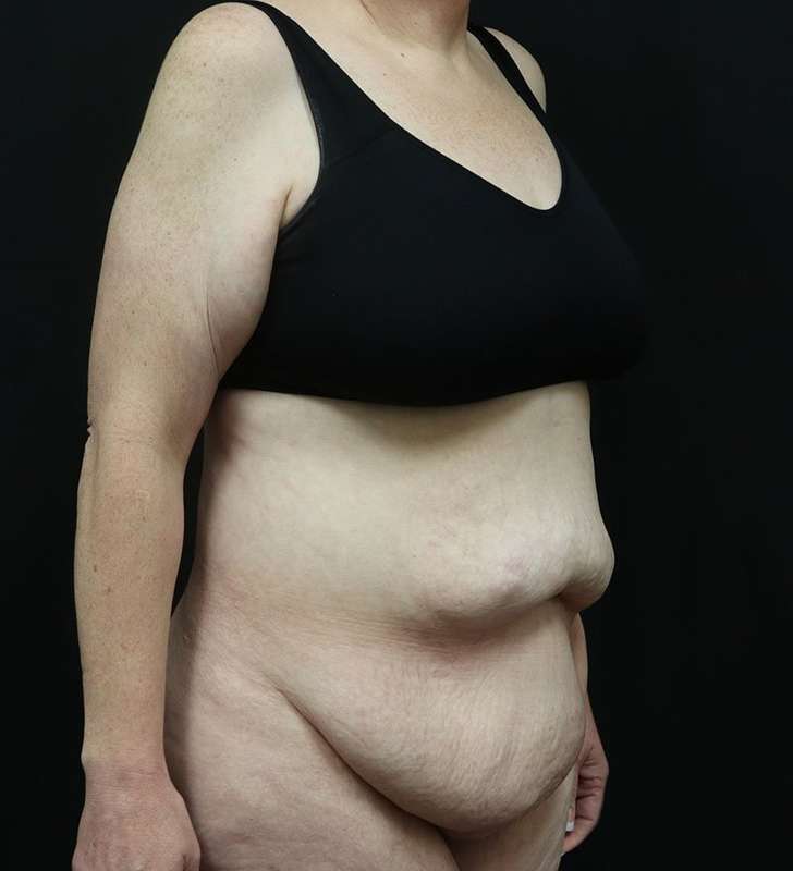 Abdominoplasty (Tummy Tuck) Before & After Patient #948