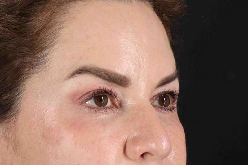 Brow Lift Before & After Patient #4843