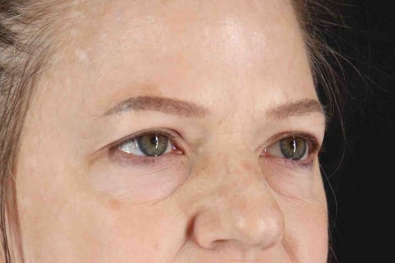Brow Lift Before & After Patient #4854